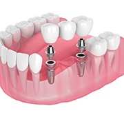 Illustration of implant bridge