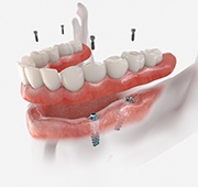 Illustration of implant denture